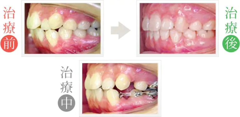 口元をすっきりさせる矯正歯科治療症例