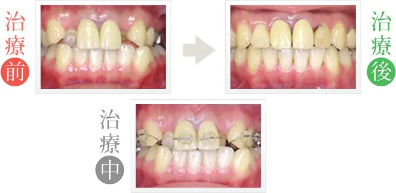噛み合わせの悪さを矯正歯科治療