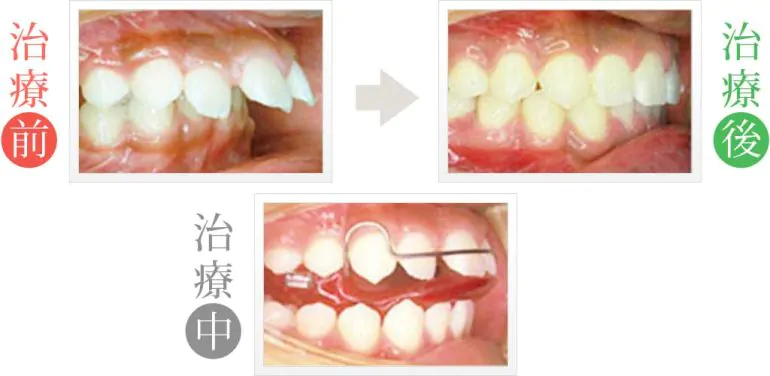 出っ歯を小児矯正治療
