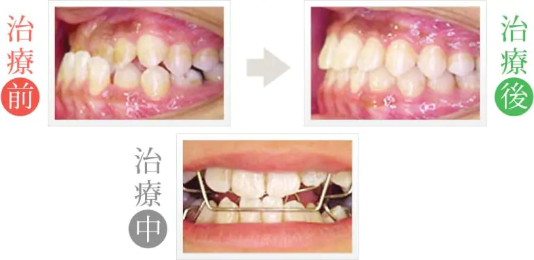 噛み合わせの悪さを小児矯正治療