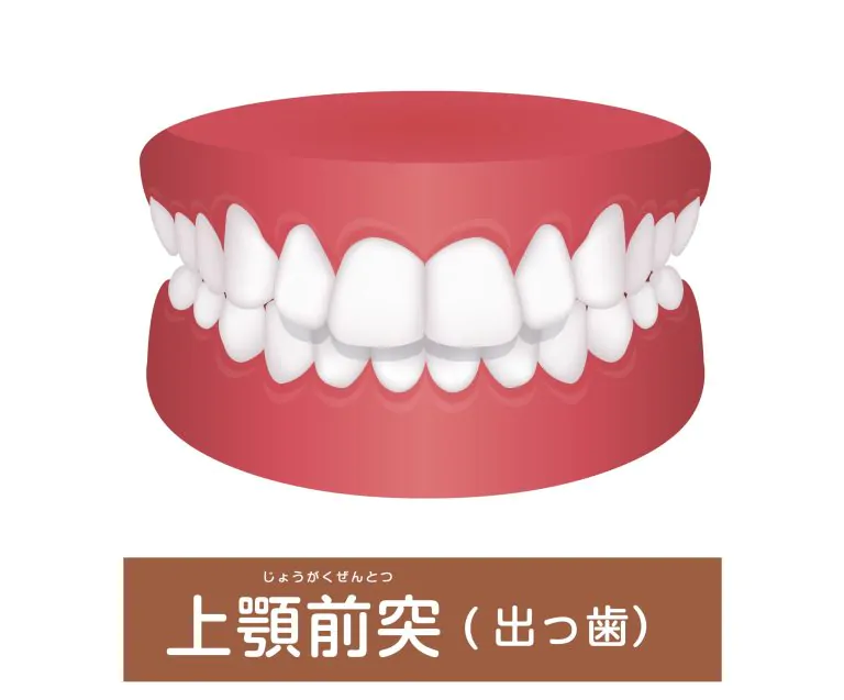 出っ歯(口ゴボ)は矯正歯科治療で歯並びキレイに