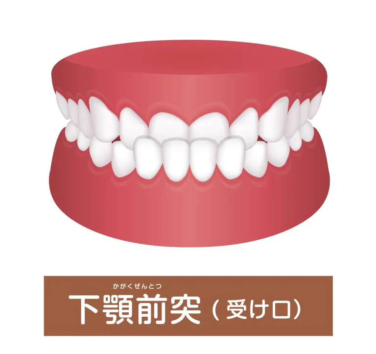 受け口(下顎前突)は矯正歯科治療で歯並びキレイに