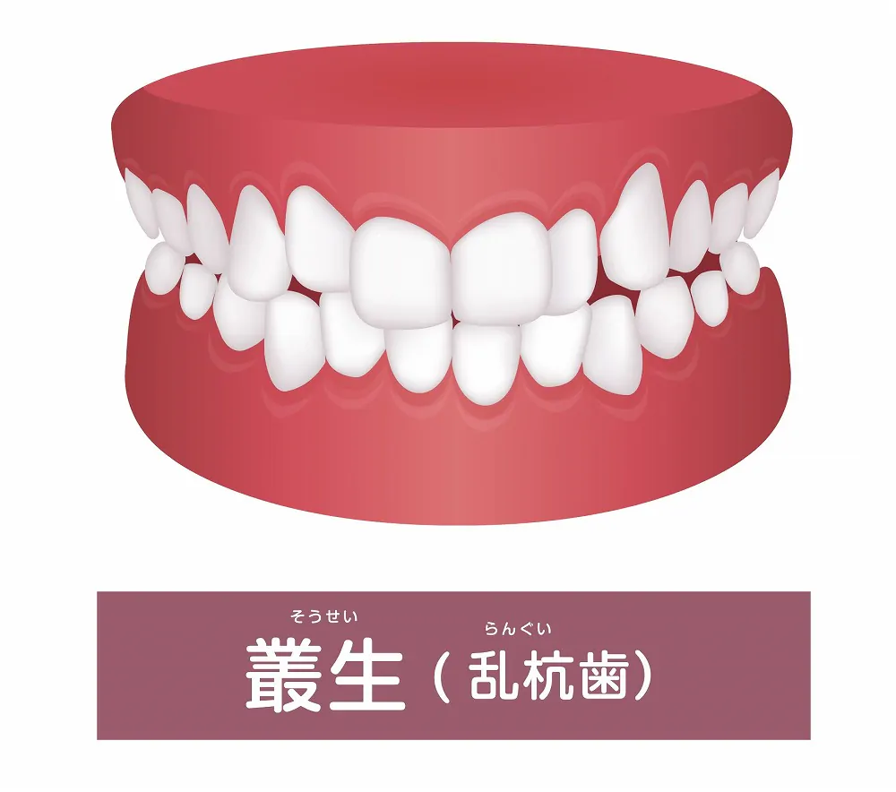 叢生（歯並びがデコボコ）